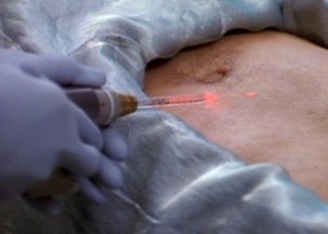 Laser scalpel.jpg